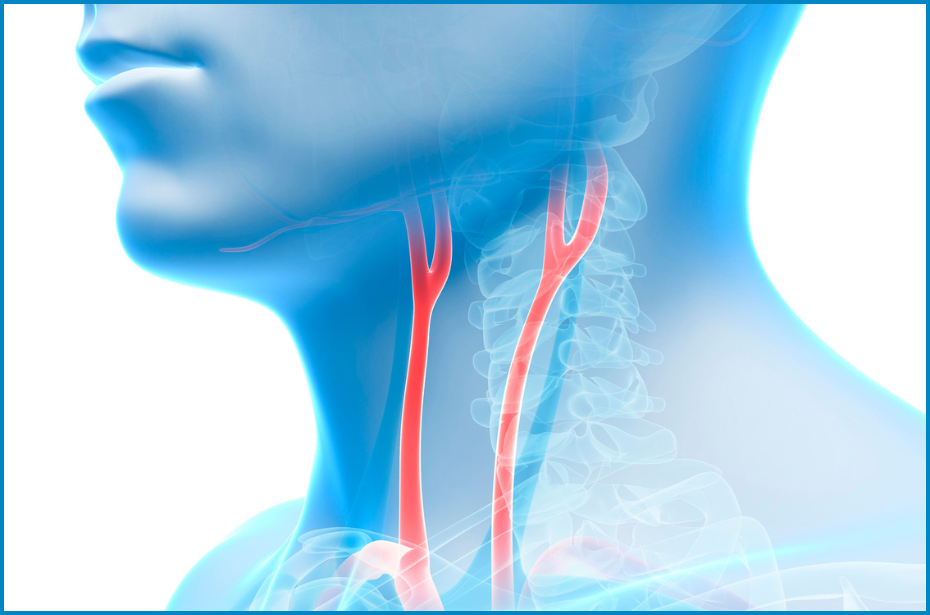 A medical illustration of the carotid artery in the neck of a male patient. The carotid artery is in red while the patient is blue.